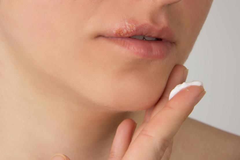 Cold Sore or Pimple – What’s the Difference?