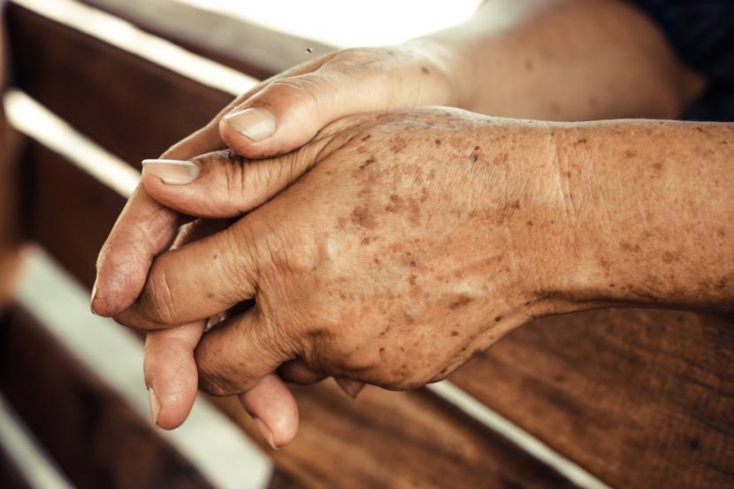 How to Treat Age Spots