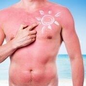 What is Sunburn?