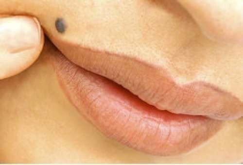 Are Moles Serious?