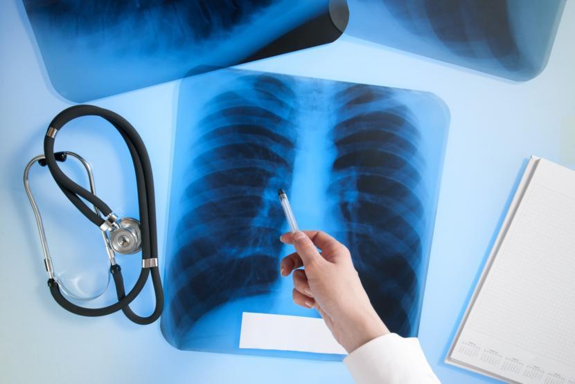 Atelectasis: Symptoms, Causes, and Treatment