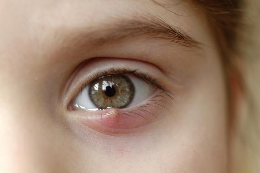 How to Get Rid of a Stye: 17 Home Remedies and Treatments