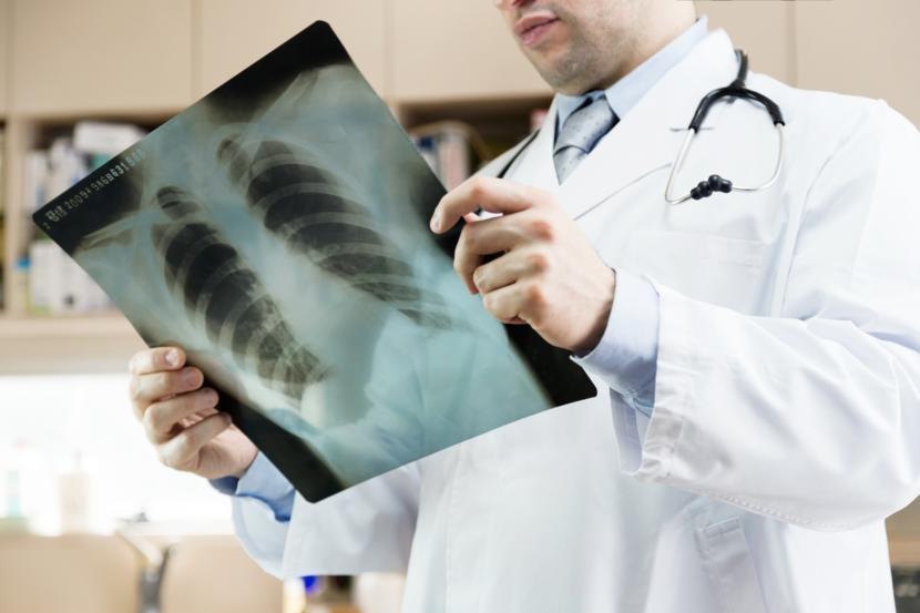 What Is Bibasilar Atelectasis?