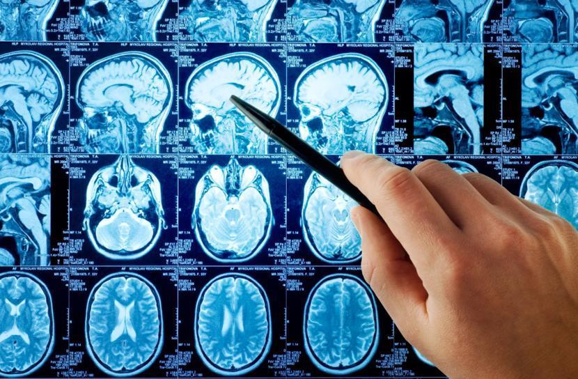 Blocking Enzymes May Be the Key to Alzheimer's Treatment