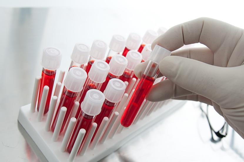 Bone Marrow Biopsies Might Not Be Necessary for Follicular Lymphoma Patients