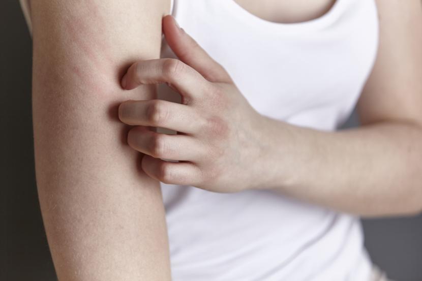Can Eczema Flare-Up Anywhere on My Body?