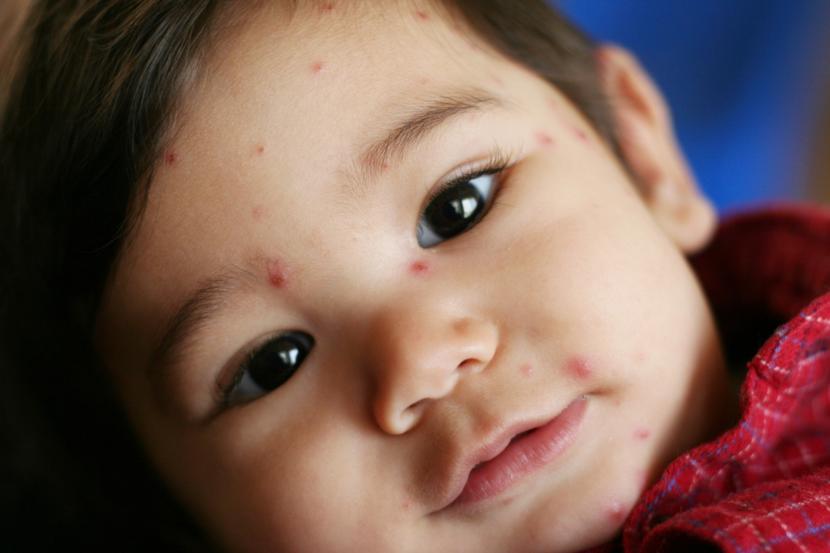 Chickenpox: Important Facts, Causes and Home Remedies
