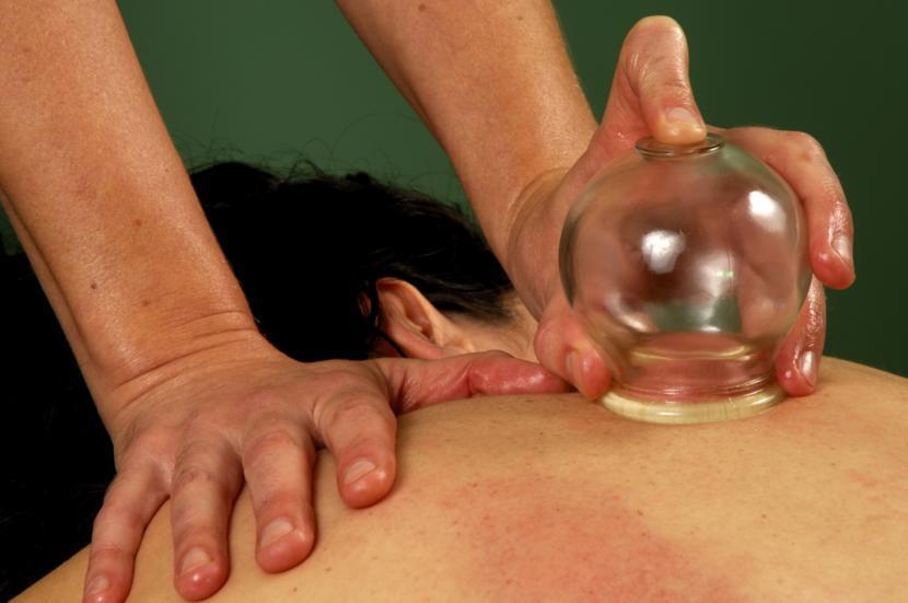 Cupping Therapy and Fibromyalgia