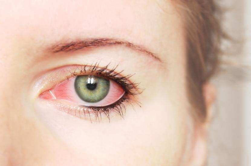 Everything You Need to Know About Conjunctivitis