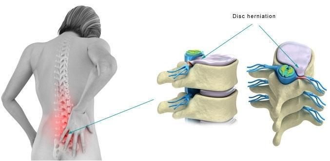 Everything You Need to Know About Disc Herniation