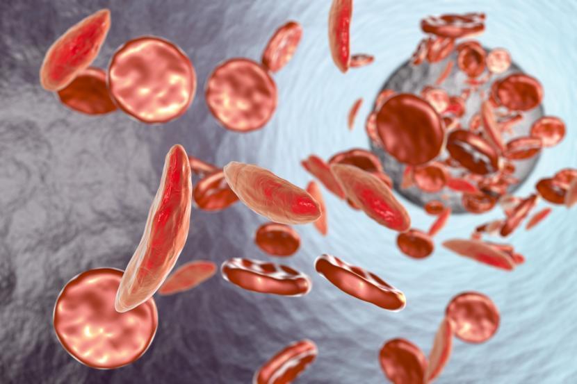 Exploring Sickle Cell Anemia