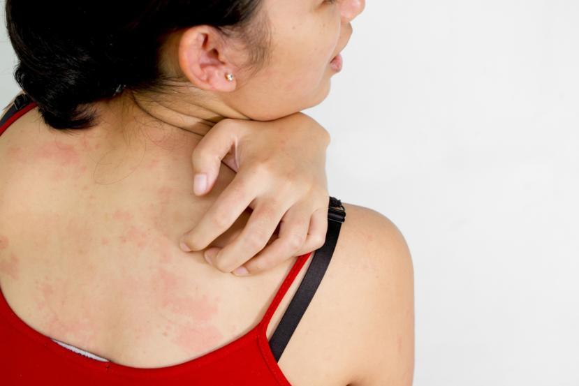 Heat Rash: When Should I See a Doctor?