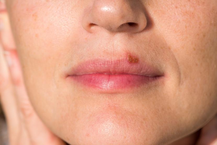 Herpes Simplex Virus: The Cause of Cold Sores