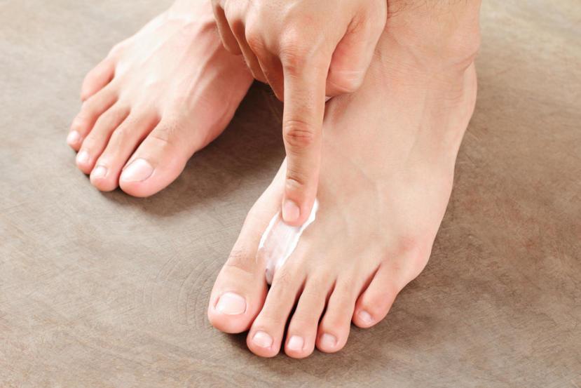 15 Home Remedies to Get Rid of Athlete's Foot