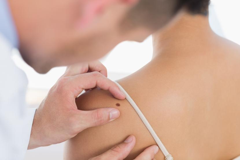 How Can Skin Grafting Treat Melanoma?