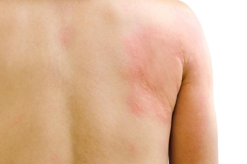 How Is Hives (Urticaria) Diagnosed?