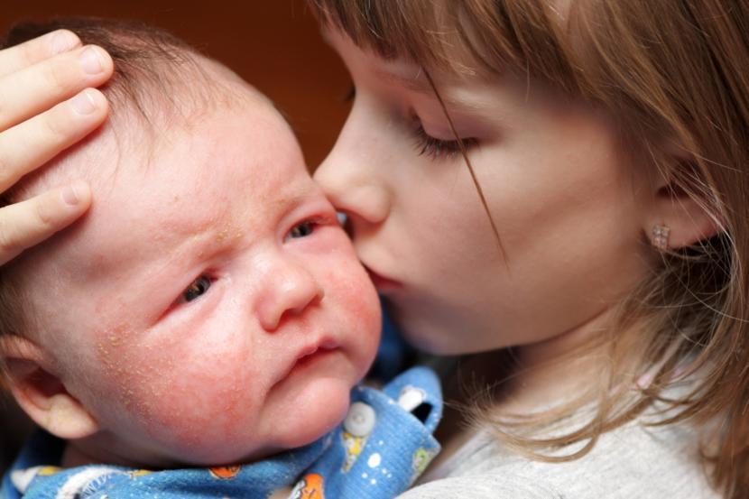 Is Eczema Contagious?