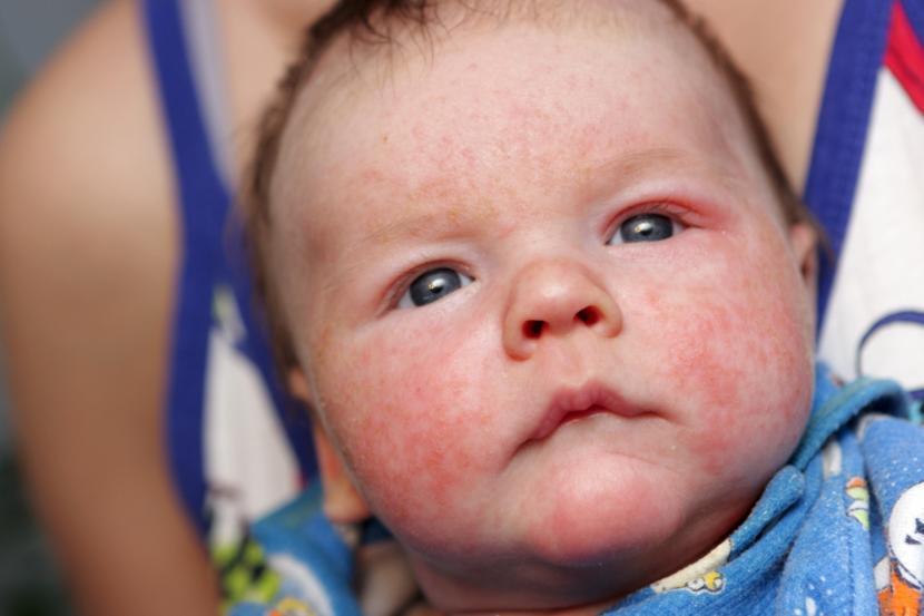 Is Eczema Genetic?
