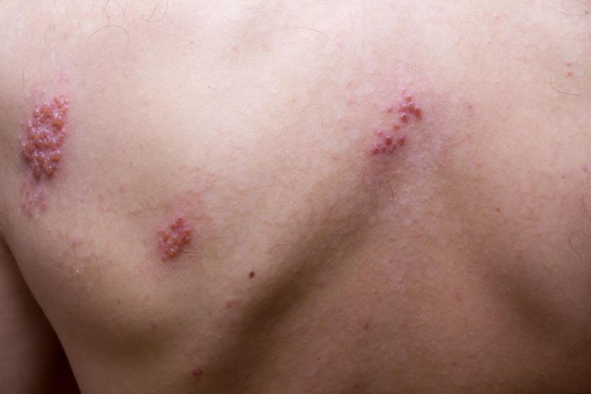 Is Rosacea Contagious?