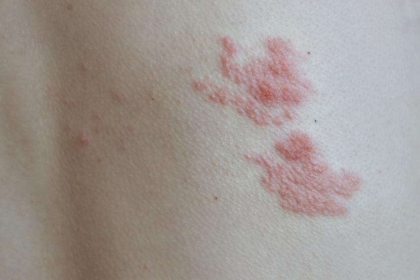 Is Shingles Contagious? How Do You Get Shingles?