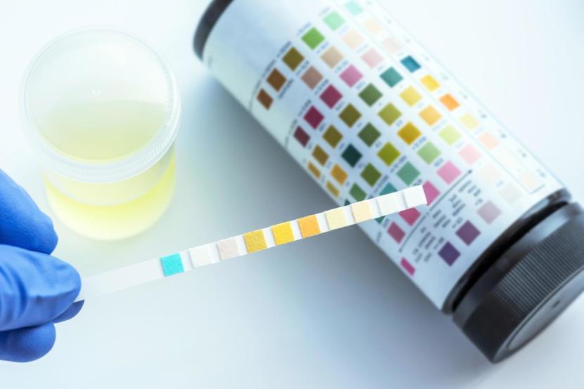 Leukocyte Esterase Urine Test
