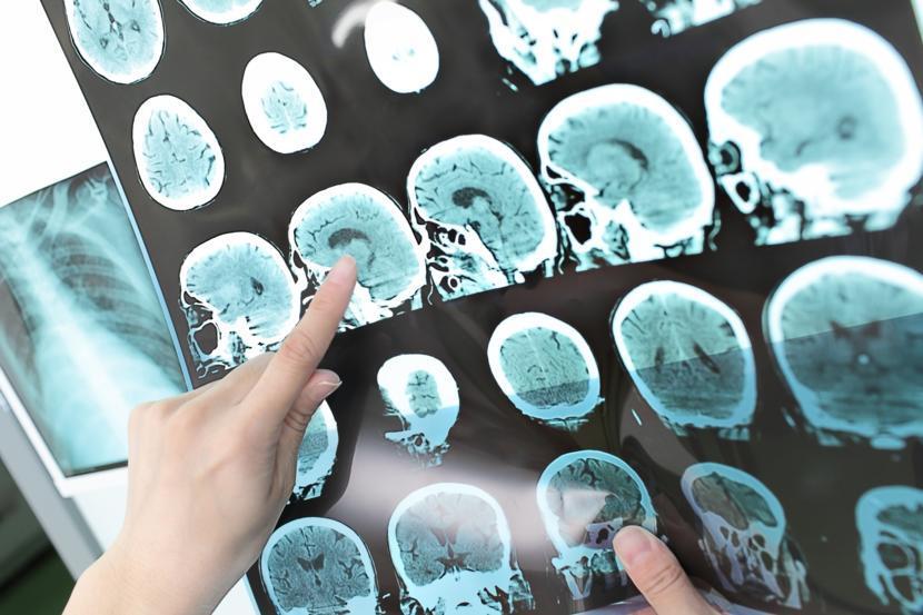 New Machine Could Detect Early Alzheimer's