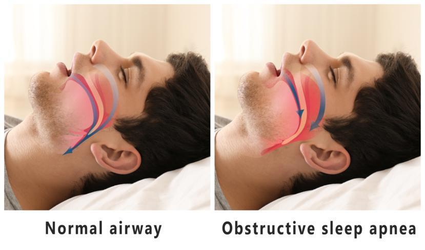 Obstructive Sleep Apnea Treatments to Reduce Cardiovascular Disease Risk