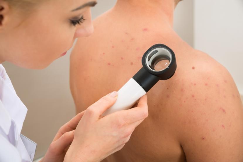 How to Treat Pinpoint Petechiae: 21 Natural Home Remedies