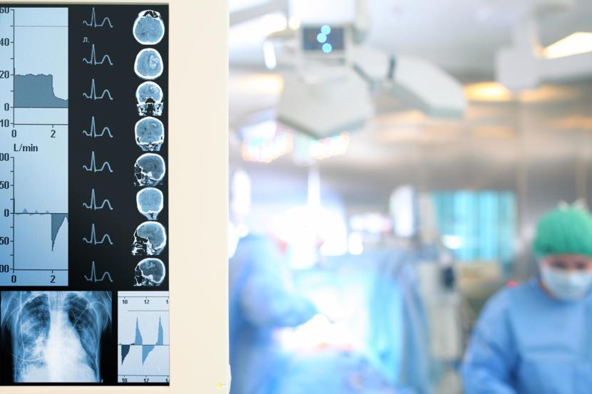 Breakthrough in Parkinson's Disease Research Allows Patients to Sleep During Deep Brain Stimulation
