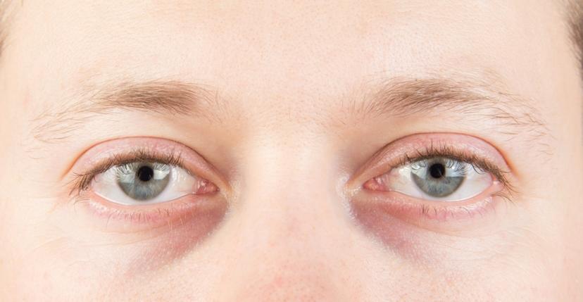 Tips to Get Rid of Your Eye Bags