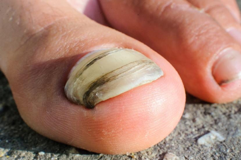 What are the Causes and Symptoms of Nail Fungus?