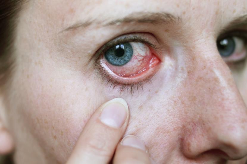 What Are the Causes of Conjunctivitis?