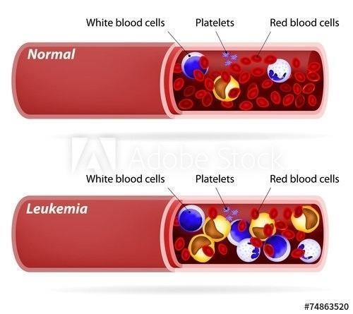 What are the Different Types of Leukemia?