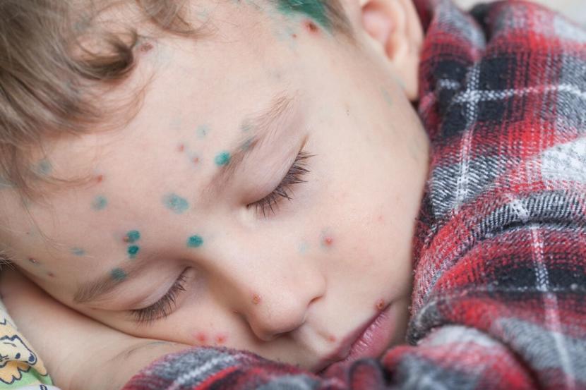What Are the Possible Complications of Chicken Pox?