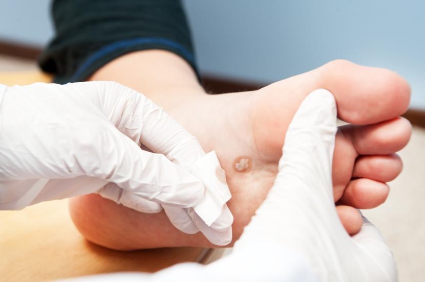 What Are Warts?