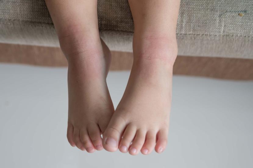 What Can Make Me Think that My Baby Has Mumps?