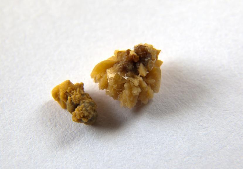 What Causes Kidney Stones? How to Prevent and Treat Kidney Stones