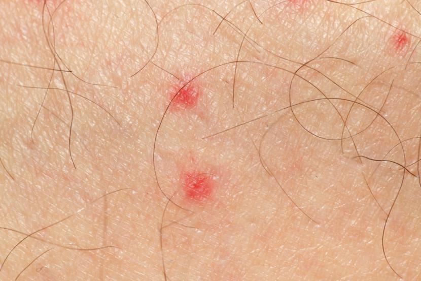 What Causes Petechiae?