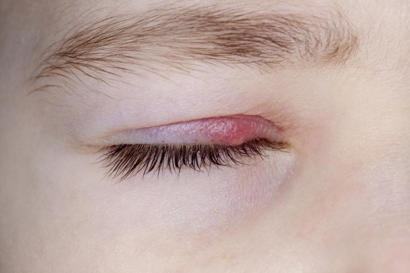 What is Blepharitis?