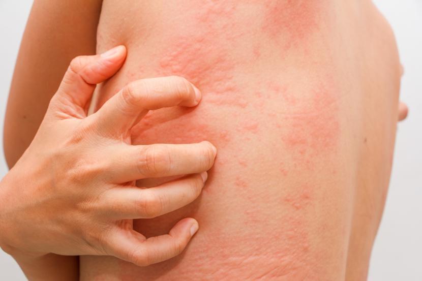 What is Candida?