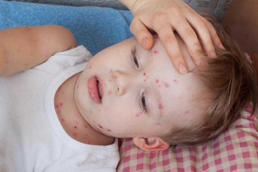 What is Chickenpox?