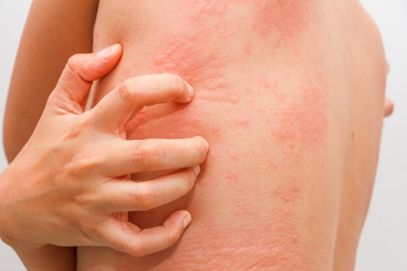 What Is Chronic Urticaria?