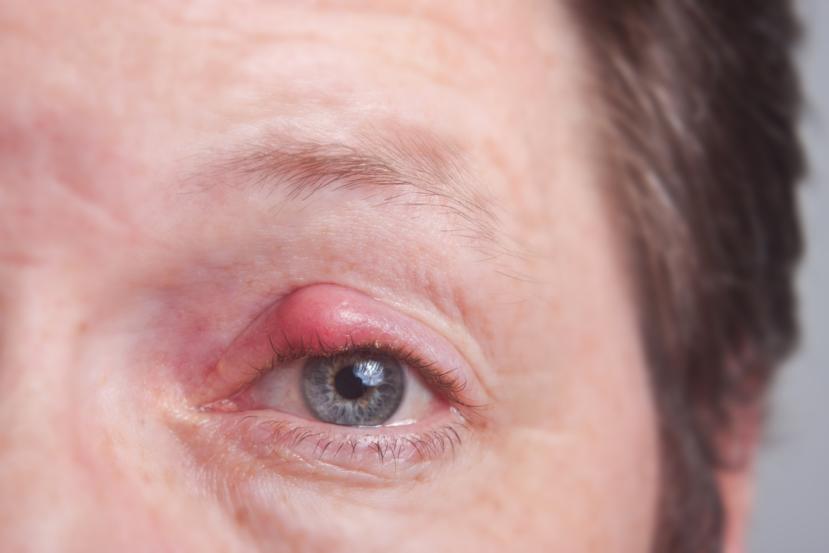 What is Eye Herpes?