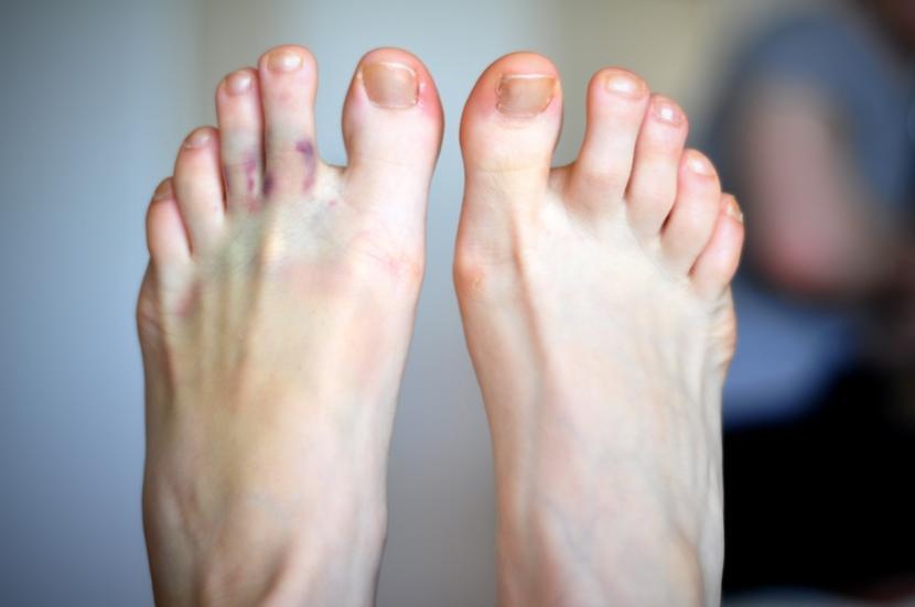 What is Gout?