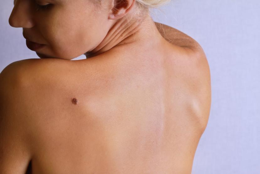 What Is Nodular Melanoma?