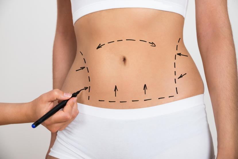 What to Expect After a Plastic Surgery