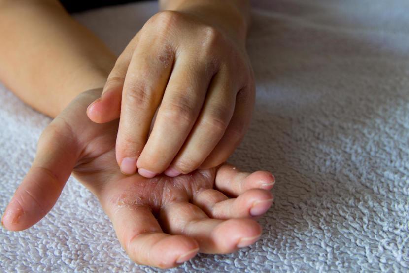 What Could Itchy Palms Mean?