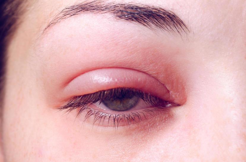 What Could a Swollen Eyelid Mean?