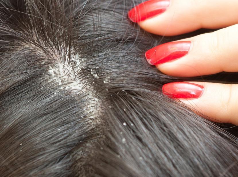 What Are the Treatment Options for Dandruff?