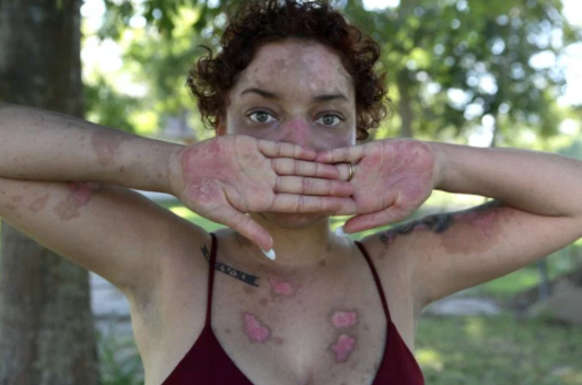Model Shares Photo of Lupus Blisters to Give Others Confidence